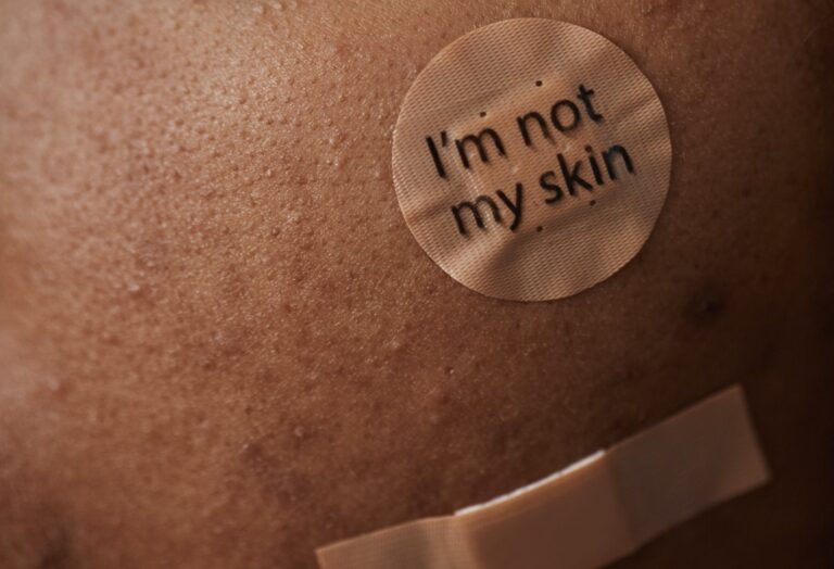 About Period Acne: Causes and Home Remedies