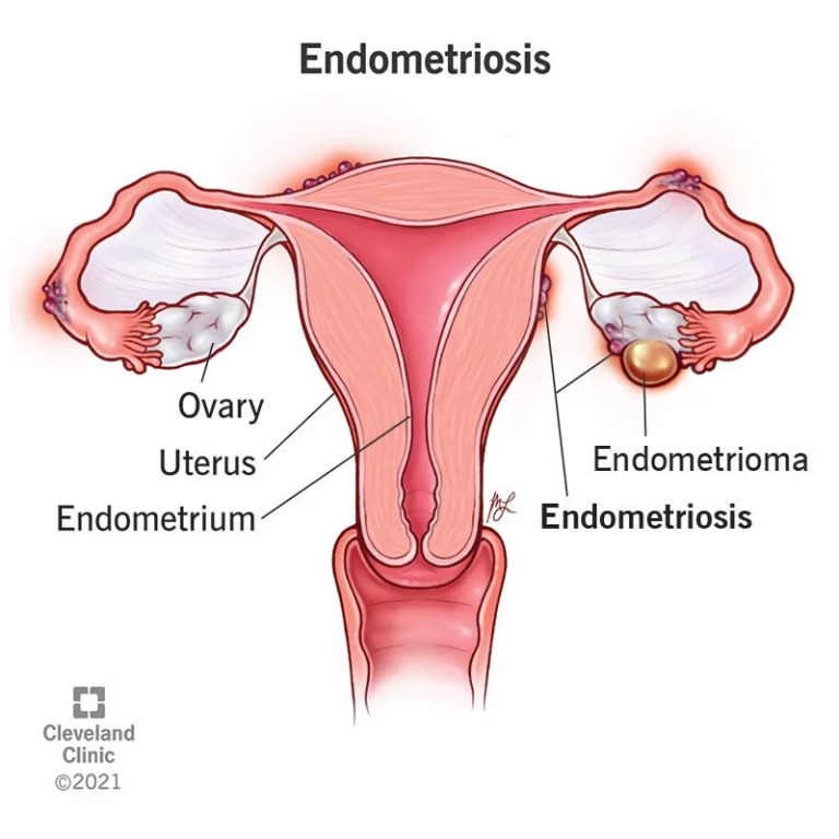 Endometriosis: A Guide to Understanding and Managing the Condition