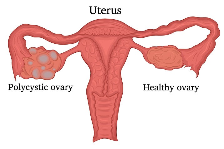 Polycystic Ovary Syndrome (PCOS): Causes, Symptoms and Management