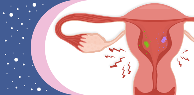 Understanding Uterine Infections: Causes, Symptoms, and Prevention