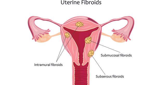 Myths vs. Facts: Dispelling Common Misconceptions About Fibroids