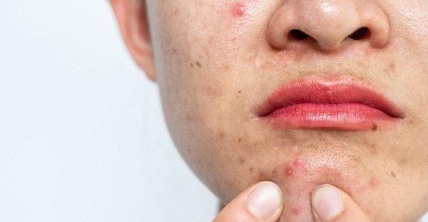 Periodic Pimples: Understanding the Science Behind PMS-Related Acne
