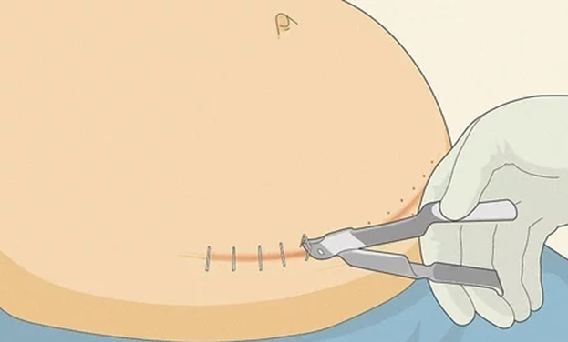 The Inside Scoop on Having a C-Section Birth