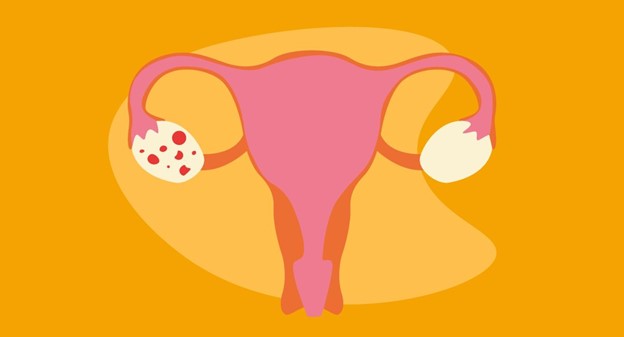 Managing PCOS: Lifestyle Changes That Can Help