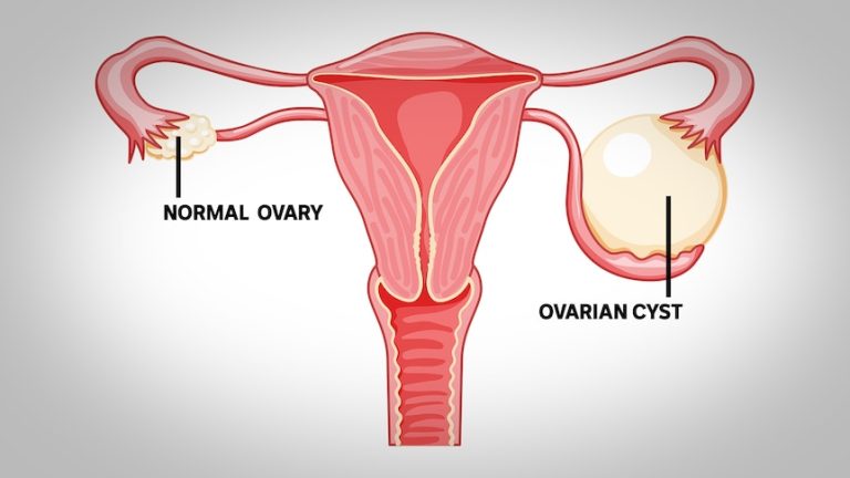 Got an Ovarian Cyst? Here’s What You Need to Know